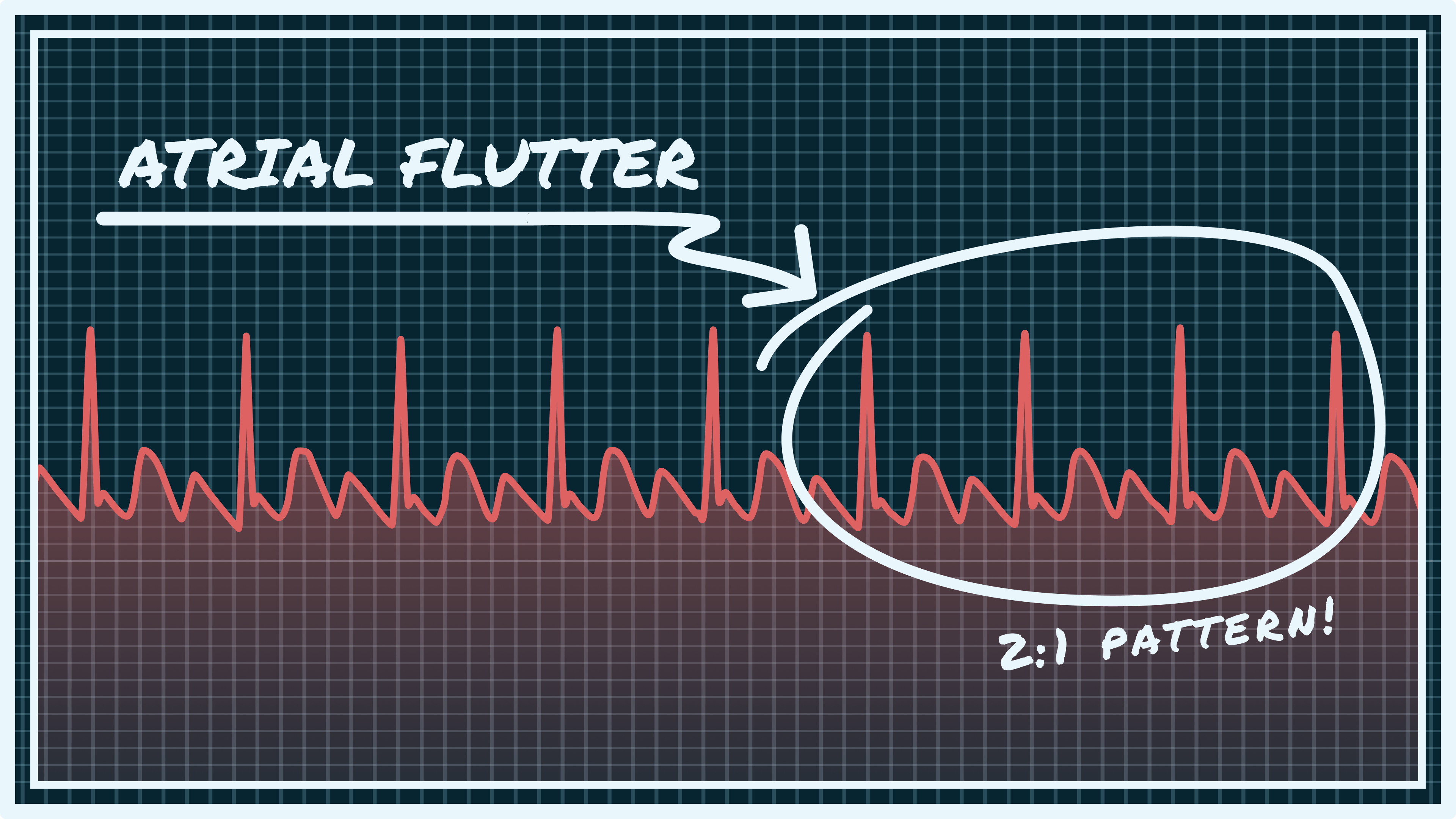 What Does Atrial Flutter Ecg Look Like Printable Templates Protal